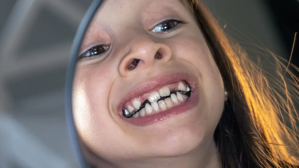 درمان نامرتب بودن دندان ها