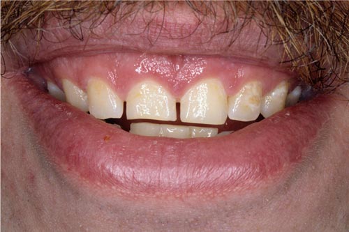 دندان های کوتاه که هنگام لبخند دیده نمی شوند