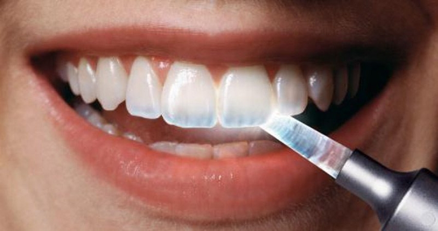 سفید کردن دندان و تاثیر آن بر مینای دندان