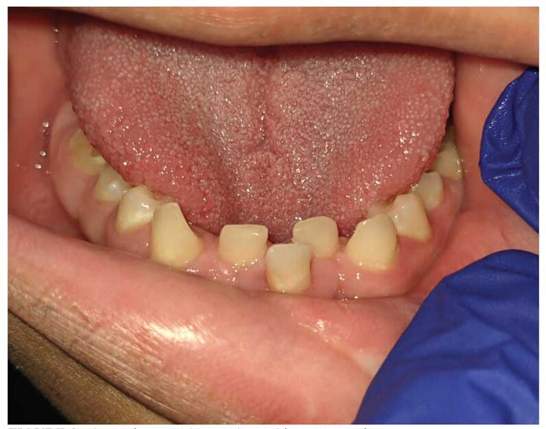 درمان دندان های کودک سندوم توسط دندانپزشک