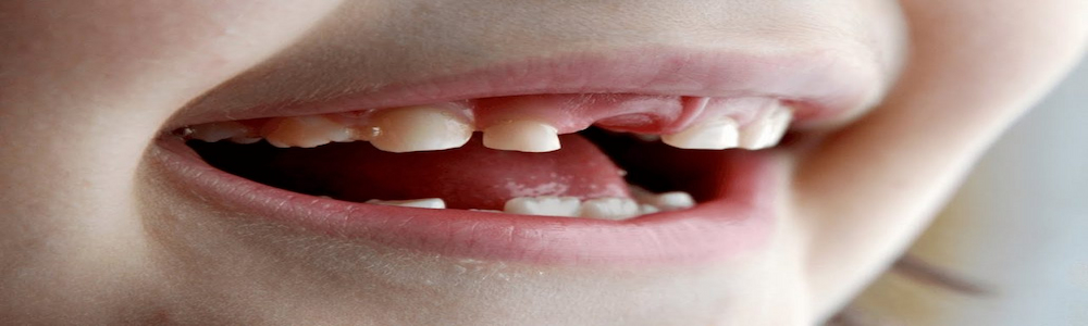 پوسیدگی دندان کودکان