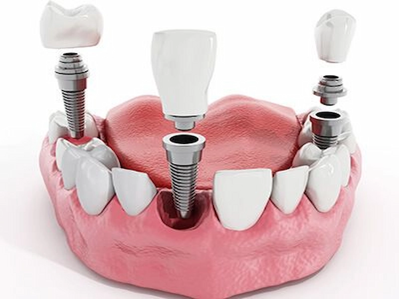 درد در کاشت دندان درد در کاشت دندان دلایل شایع آن dentis implant