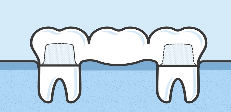 پل های دندانی