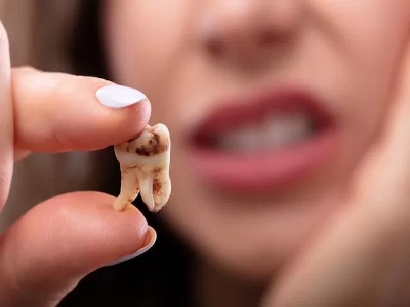 درمان سوراخ دندان