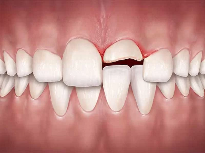 ترومای دندان