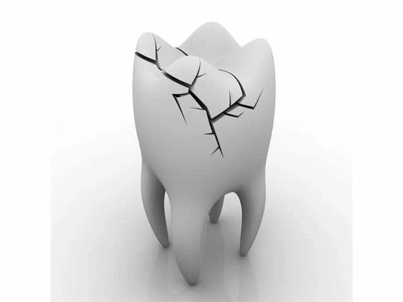 ترومای دندان -شکستگی کامل دندن