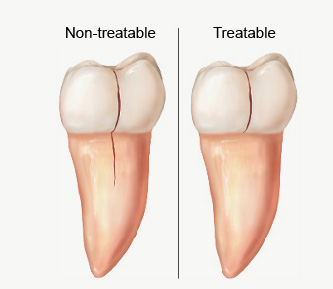 شکستگی دندان