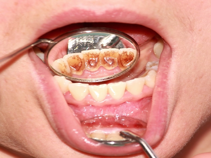 4 بیماری نادر دندان