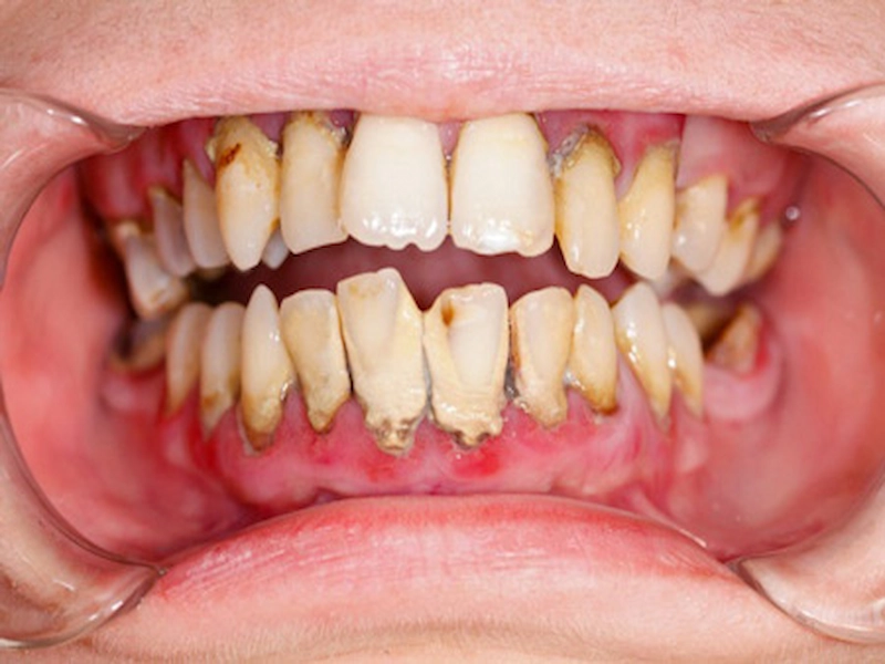بیماری های خو ایمنی و سلامت دندان
