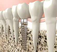 ایمپلنت به سلامت دندان کمک می کند