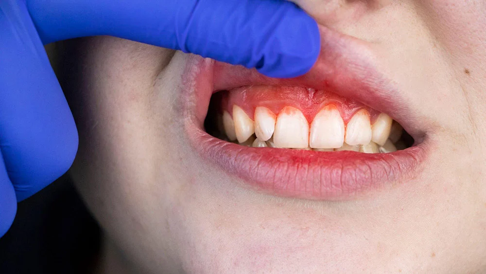 راه های سفید شدن دندان در دندانپزشکی