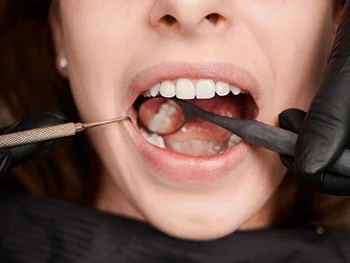 مرحله اول معاینه دندان