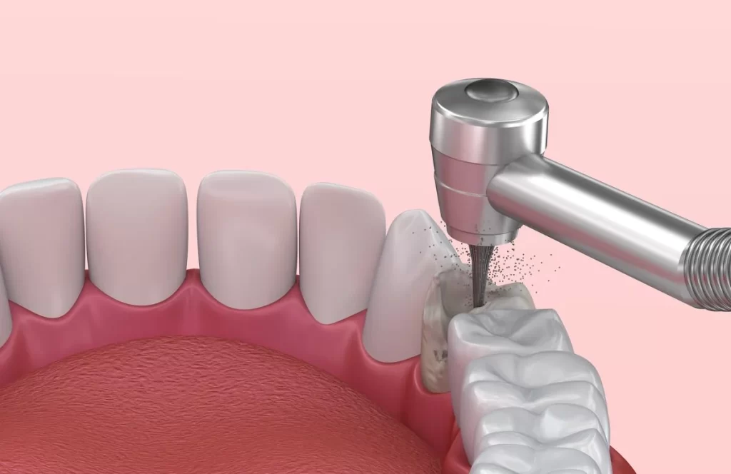 مراحل ایمپلنت بعد از کشیدن دندان