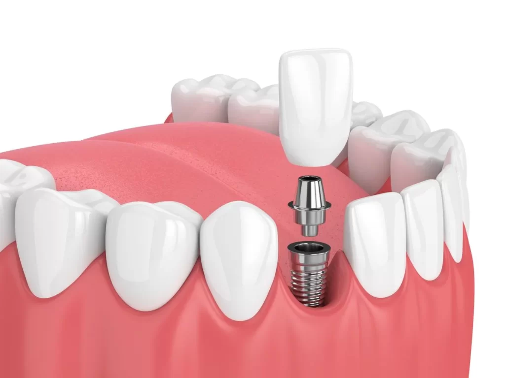مراحل ایمپلنت دندان به ترتیب