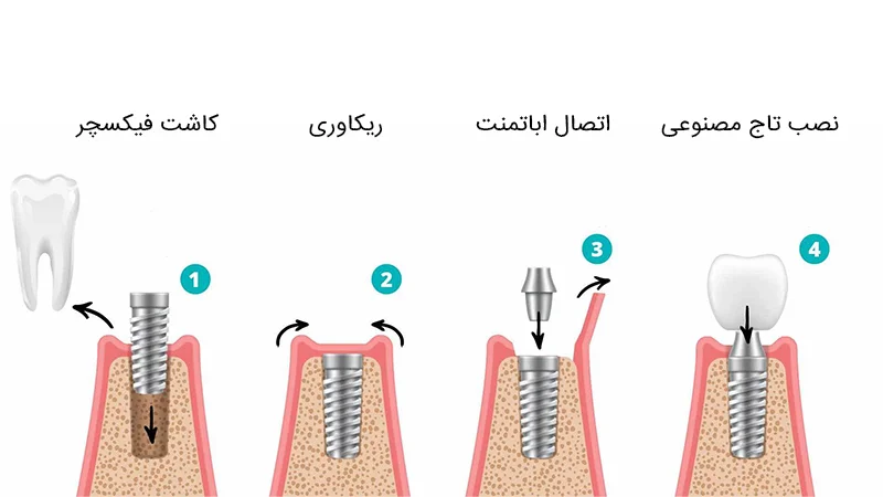مراحل ایمپلنت بعد از کشیدن دندان