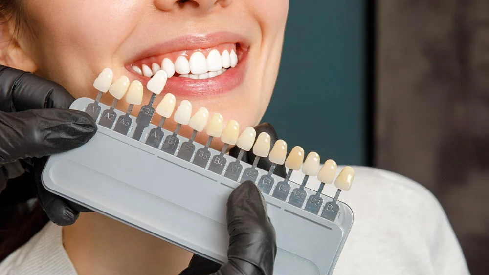 انواع کامپوزیت دندانپزشکی