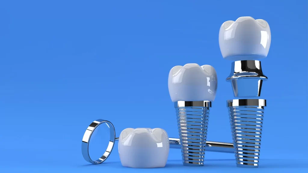 انواع ایمپلنت دندانپزشکی