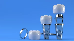 انواع ایمپلنت دندانپزشکی
