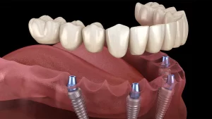 ایمپلنت کامل دندان