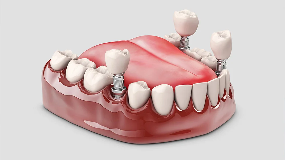 ایمپلنت کامل دندان چقدر طول میکشد

